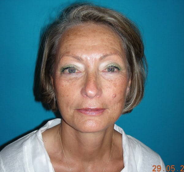 4 mois après lifting cervico-facial et blépharoplastie