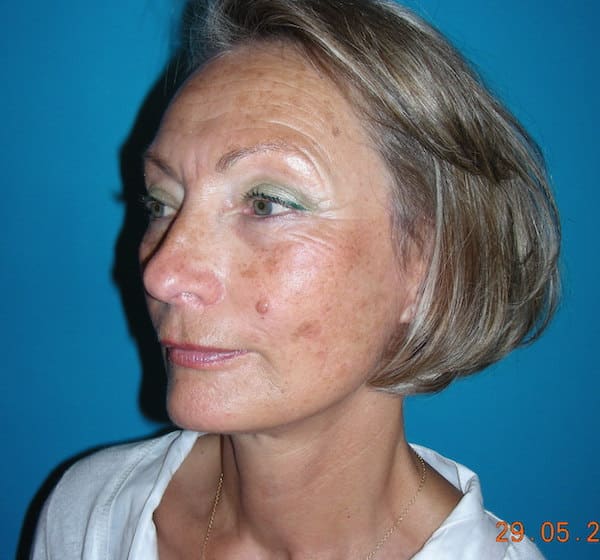 4 mois après lifting cervico-facial et blépharoplastie