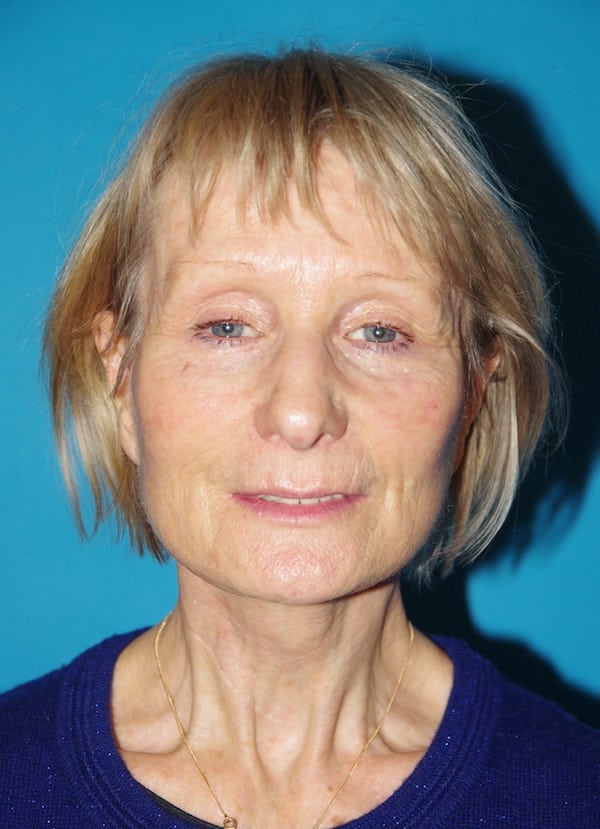 4 mois après lifting cervico-facial et lipostructure (transfert de graisse)