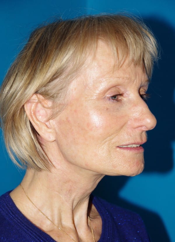 4 mois après lifting cervico-facial et lipostructure (transfert de graisse)