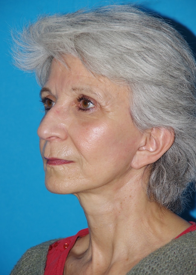 6 mois après lifting cervico-facial