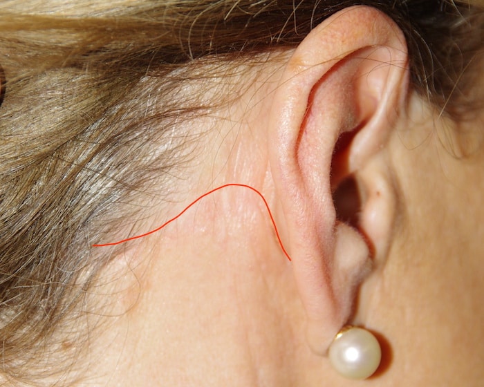 Trajet de la cicatrice derrière l’oreille après lifting cervico-facial