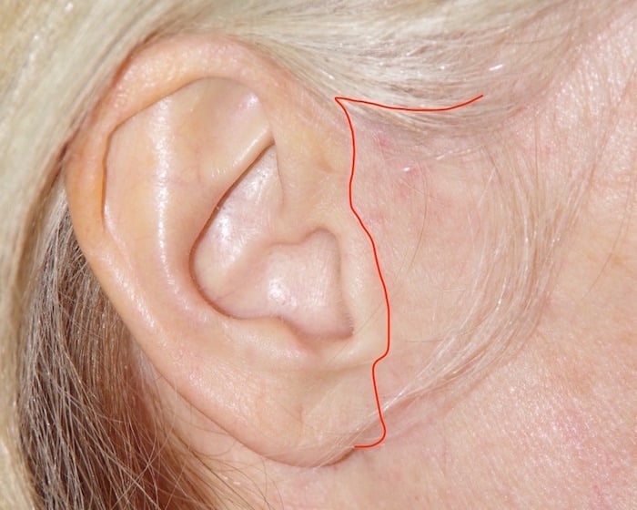 Trajet de la cicatrice devant l’oreille après lifting cervico-facial