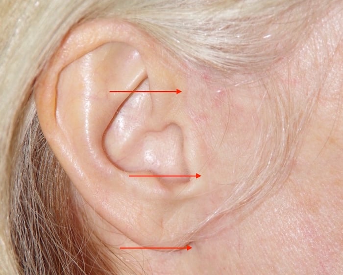 Cicatrice devant l’oreille plusieurs mois après lifting cervico-facial
