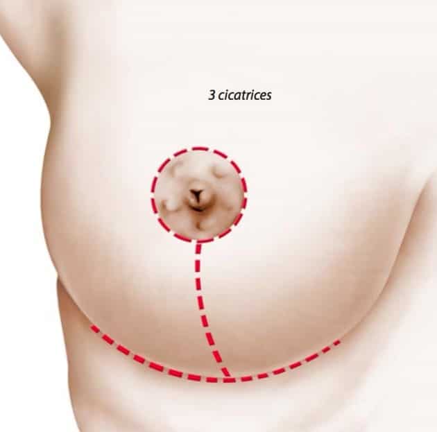 Cicatrices en ancre après lifting des seins