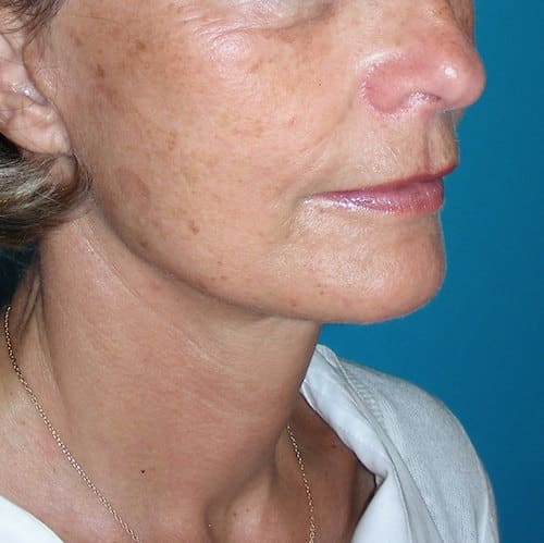 Ovale du visage redessiné après lifting cervico-facial