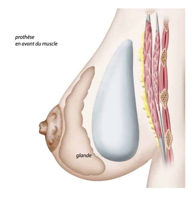 Implant mammaire en position pré-pectorale (rétro-glandulaire)