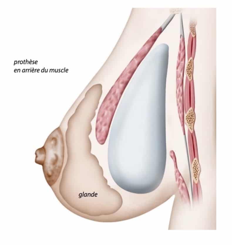 Implant mammaire en position rétro-pectorale