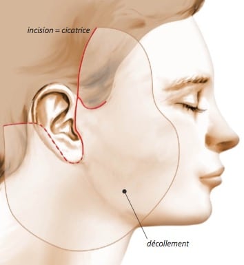 Incision et décollement de la peau lors d’un lifting cervico-facial