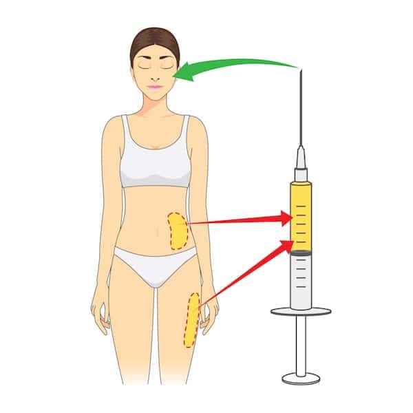 Schéma du transfert de graisse sur le visage (lipostructure)