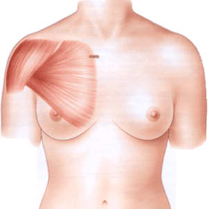 Muscle grand pectoral recouvrant l’implant mammaire