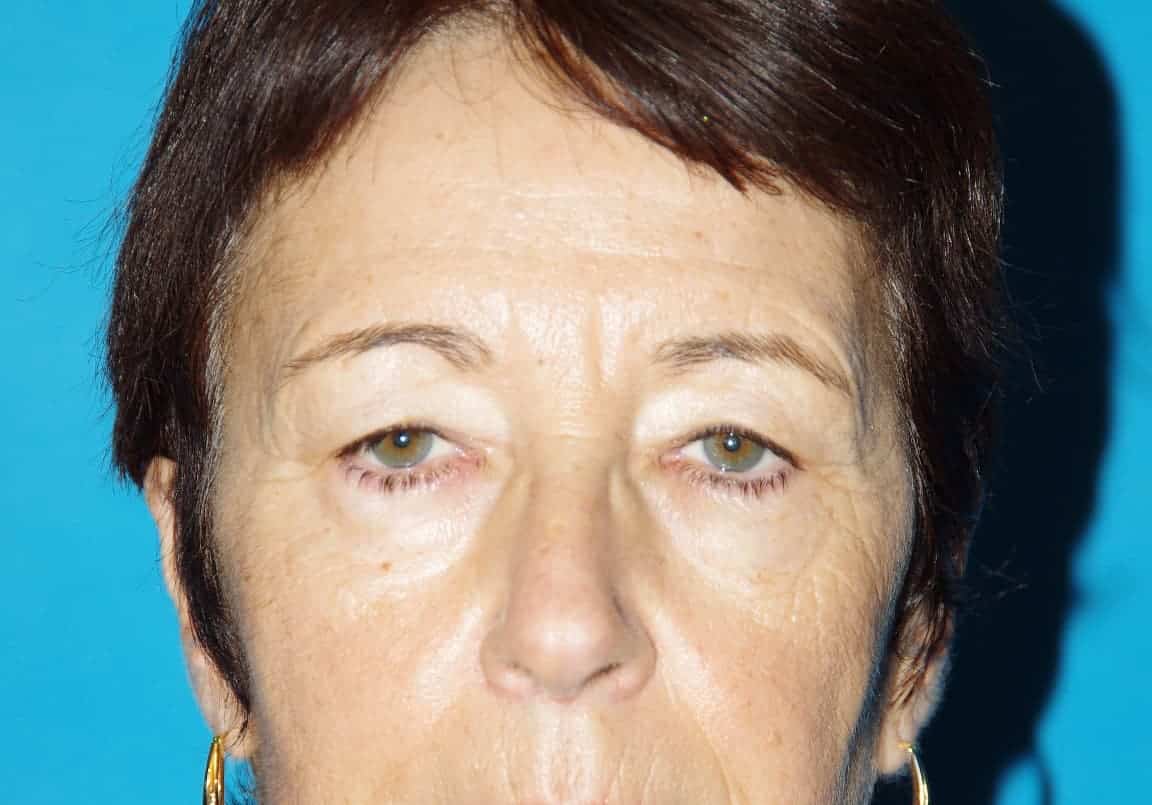Avant lifting fronto-temporal : sourcil affaissé et excès de peau de la paupière