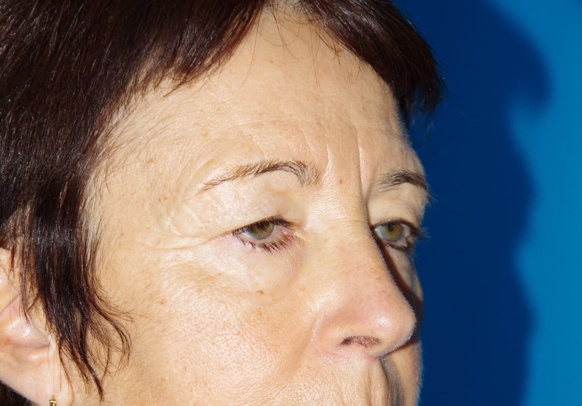 Avant lifting fronto-temporal, de face