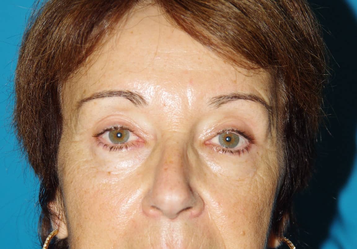 6 mois après lifting fronto-temporal et blépharoplastie supérieure
