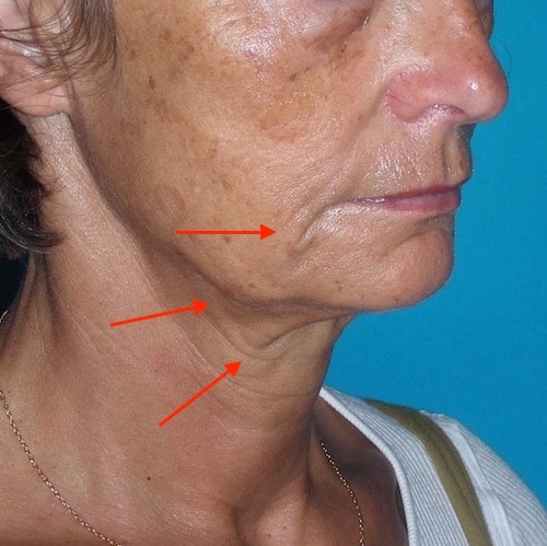 Relâchement du bas du visage : pli d’amertume, bajoue et cou